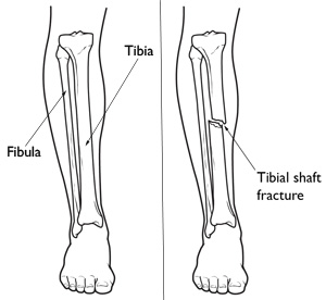 Bones - Anatomy tibula fibula diagram 